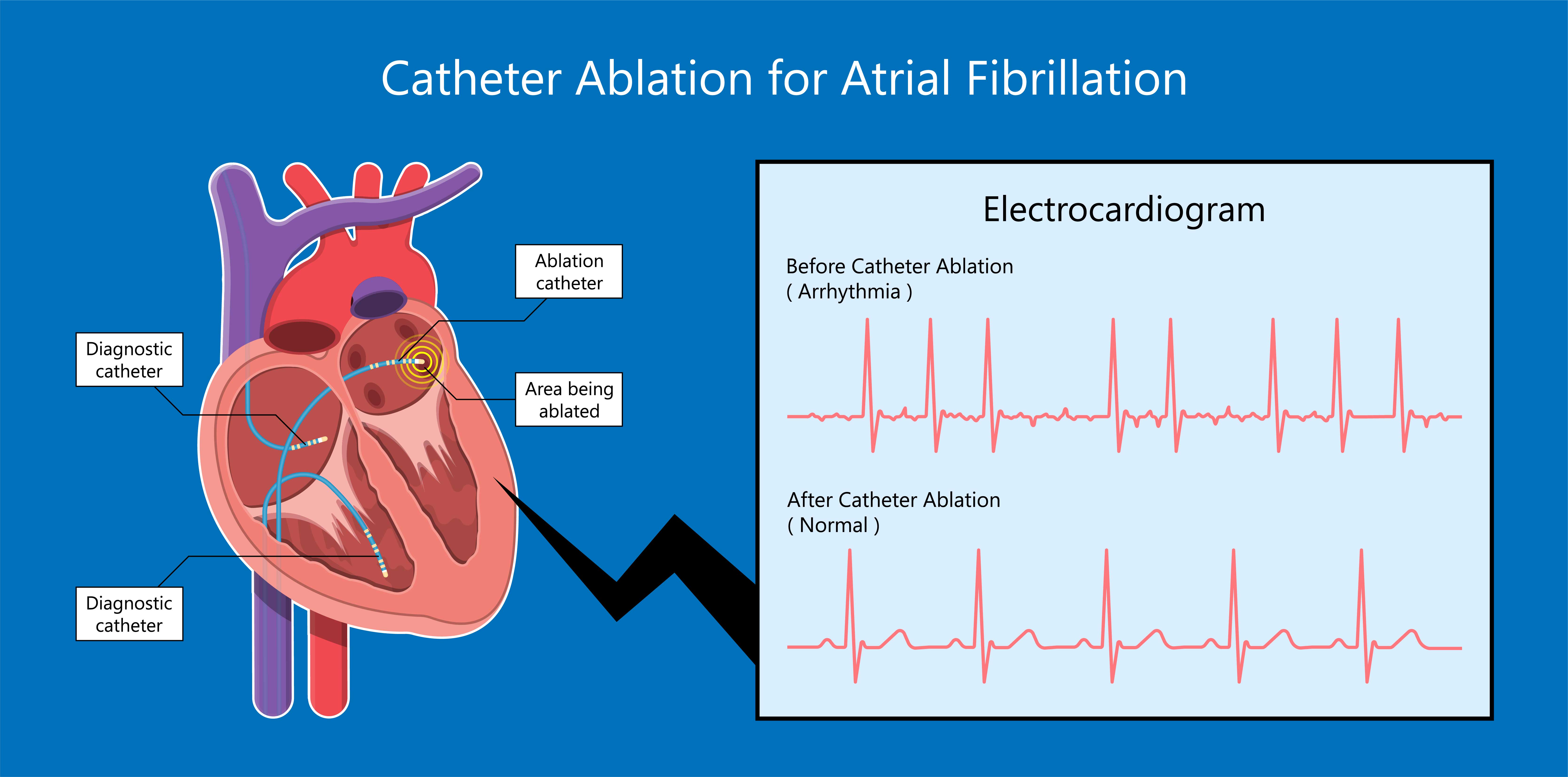 Atrial Fibrillation