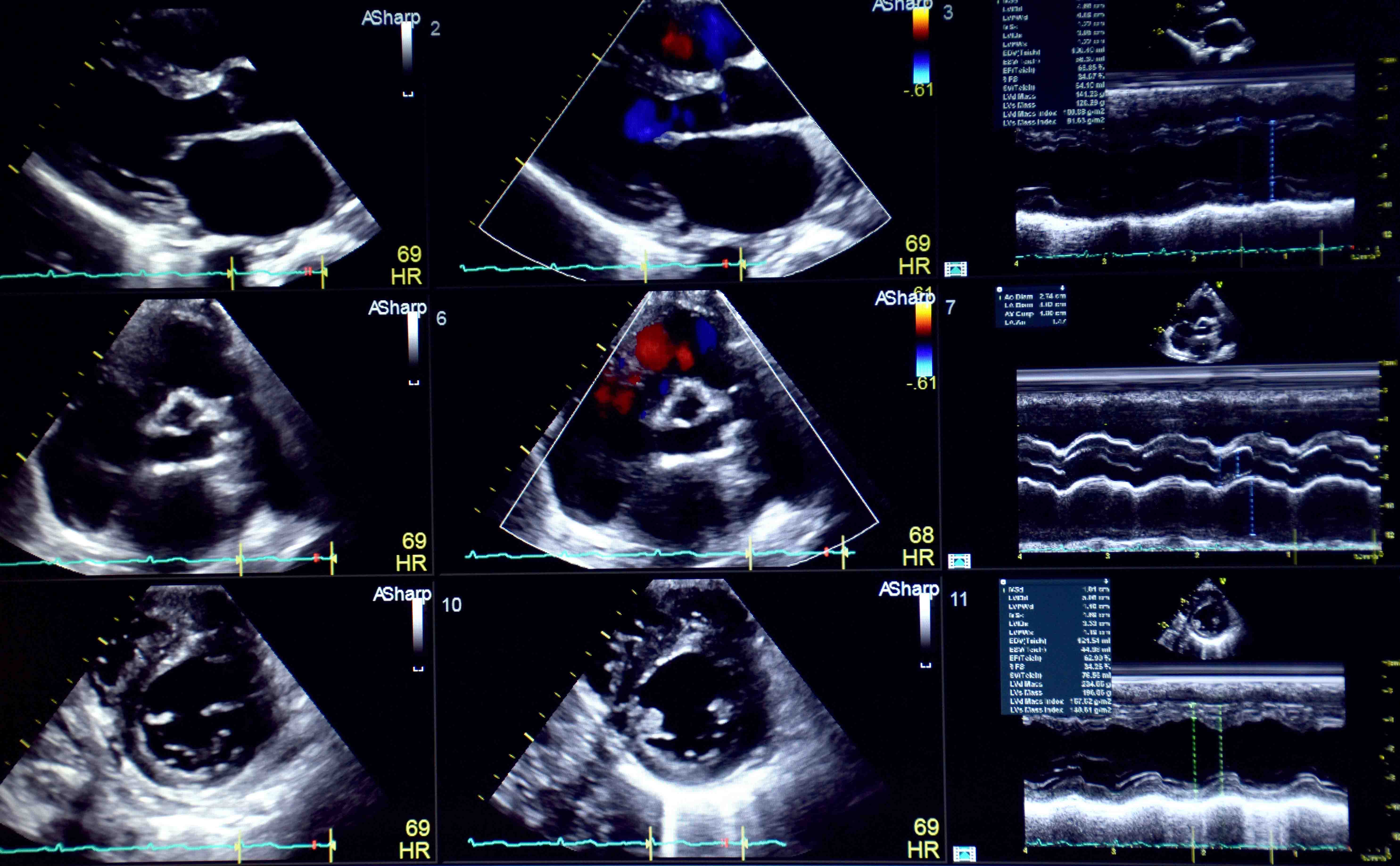 Echocardiogram