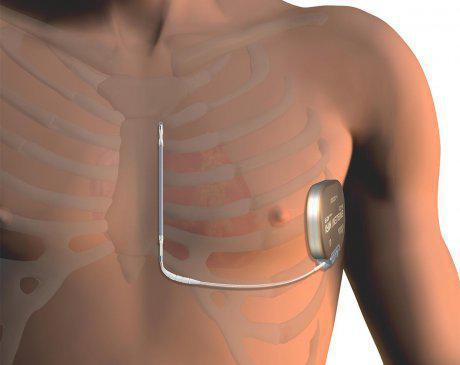 Implantable Cardioverter Defibrillator